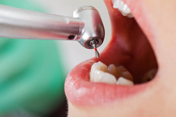 Best Urgent Care for Lost Fillings or Crowns in New Hope, MS